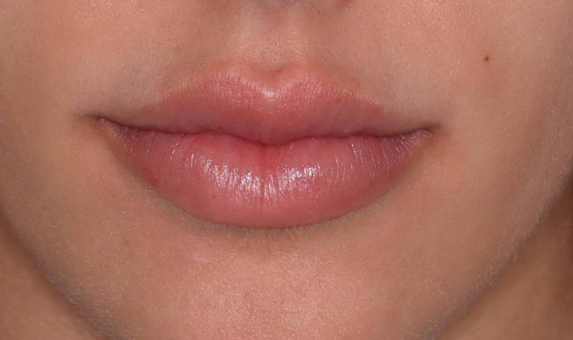 Filler Lips - Case #6 After