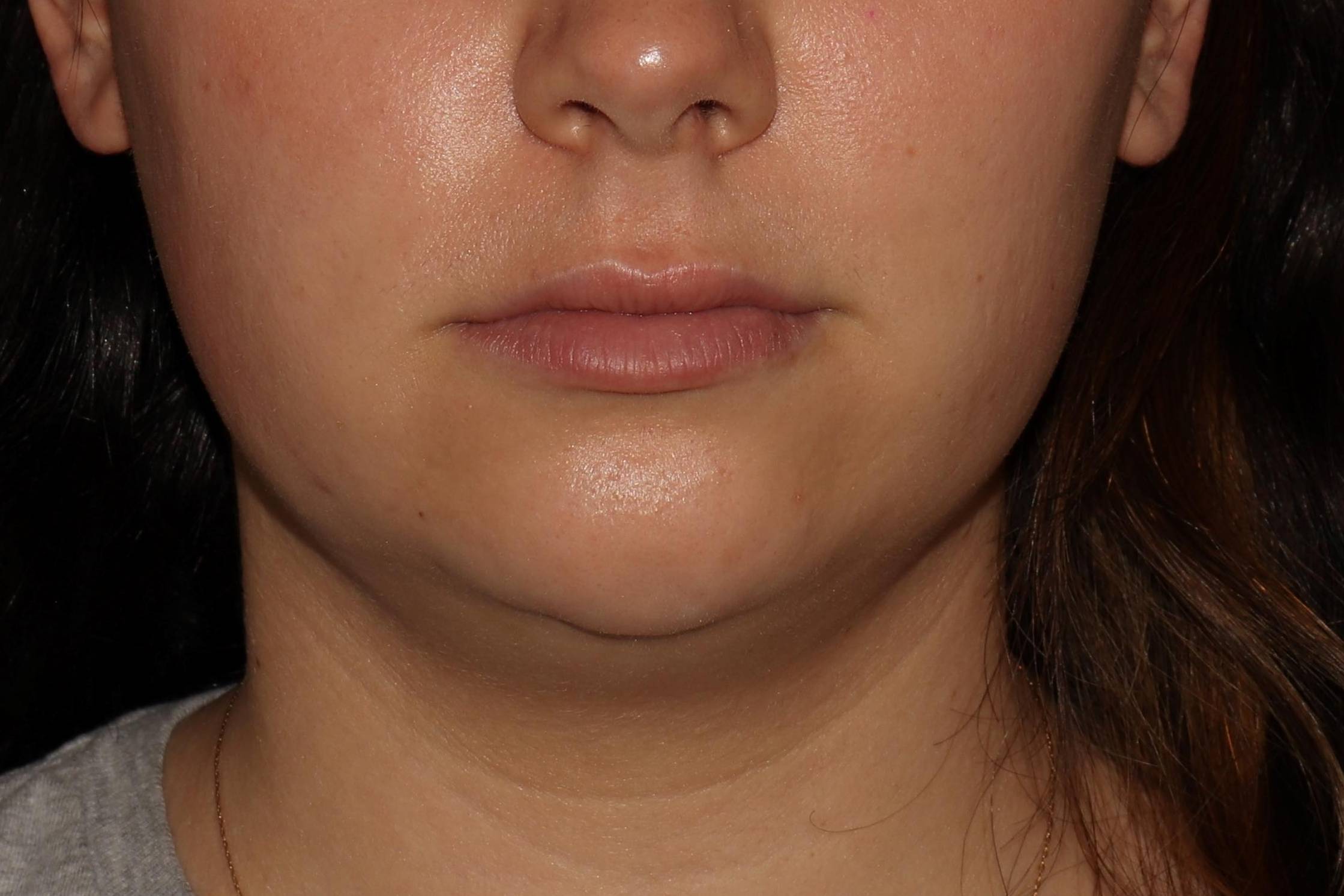 Kybella -Case #7 Before