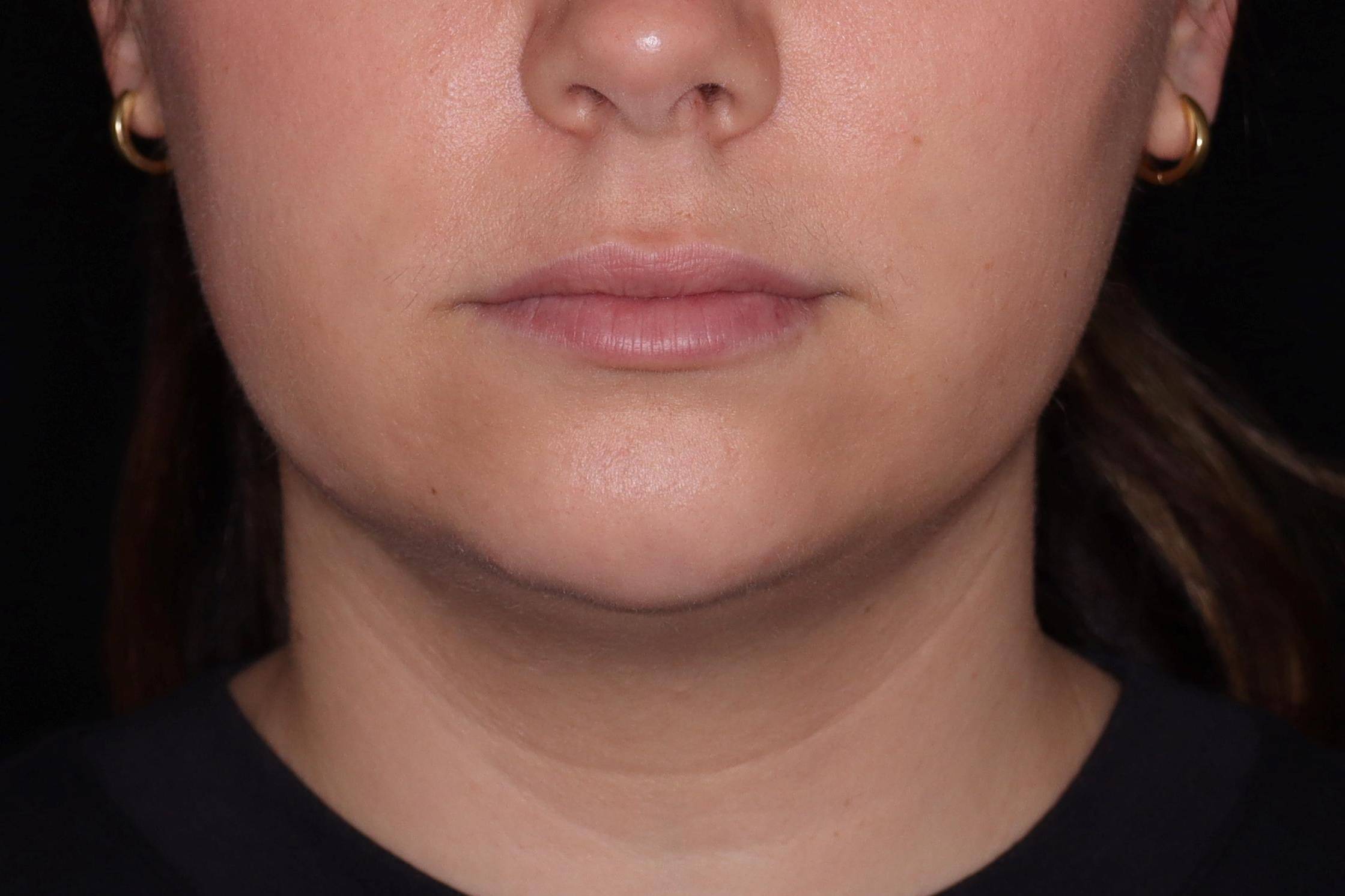 Kybella -Case #7 After