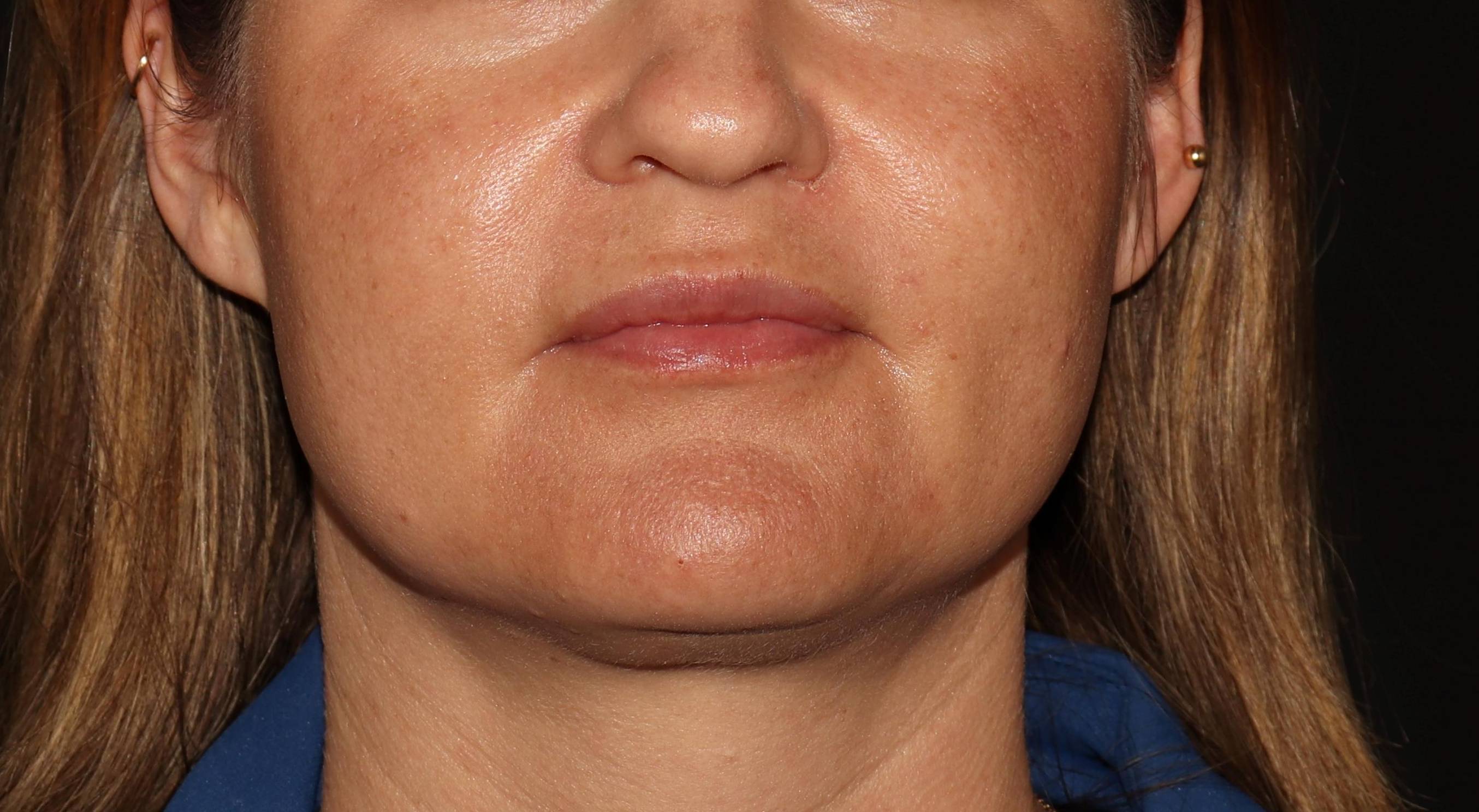 Botox- Case #10 Before