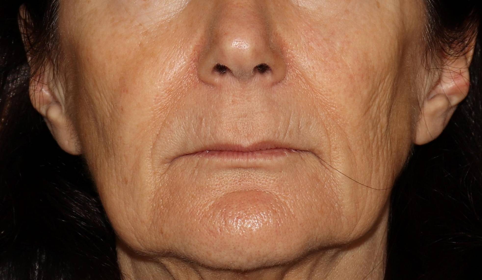 Filler Sculptra-Case #2 Before