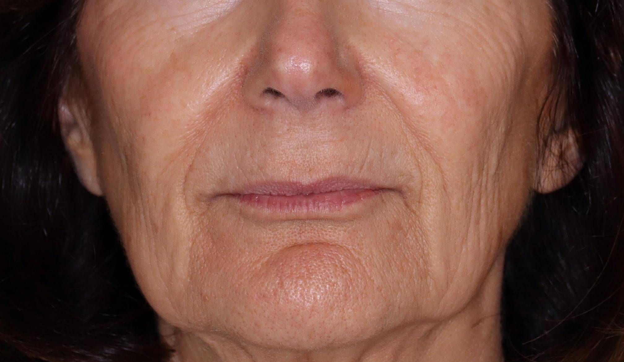 Filler Sculptra-Case #2 After