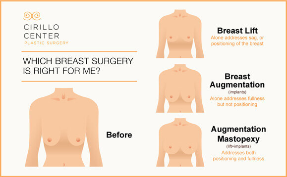 Breast Lift Surgery (Mastopexy): Purpose, Side Effects, Risks